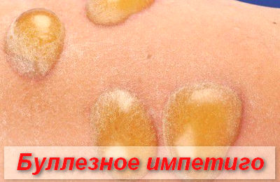 буллезное импетиго
