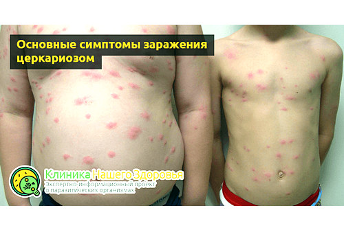 Основные симптомы заражения