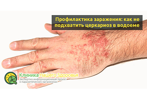 Профилактика заражения