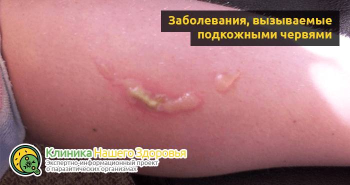 Черви под кожей человека: виды, симптомы, последствия и лечение