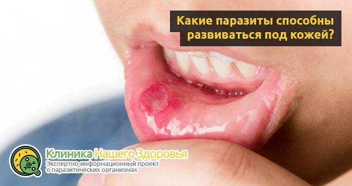 Черви под кожей человека: виды, симптомы, последствия и лечение