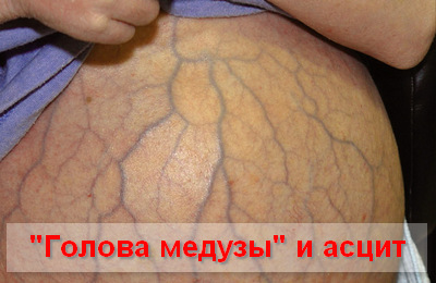 причины цирроза печени