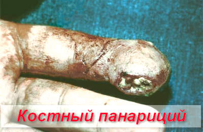 костный панариций