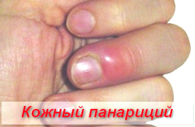 кожный панариций