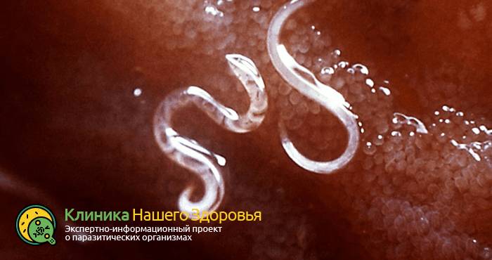 Лечение описторхоза народной медициной в домашних условиях: рецепты и советы