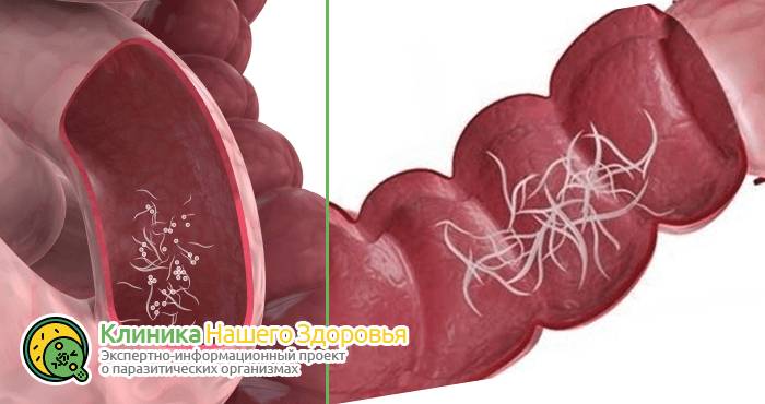 Как избавиться от остриц: лечение в домашних условиях