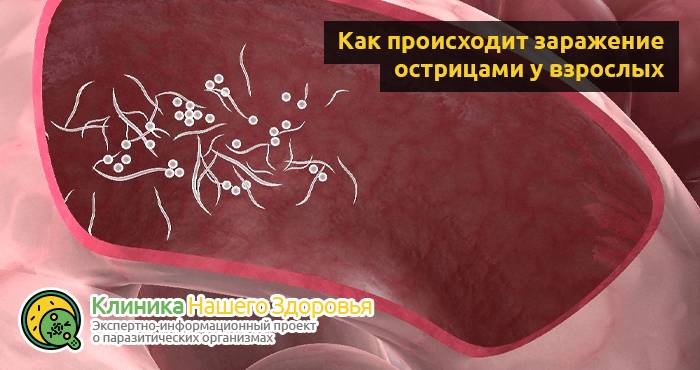 Острицы у взрослых: симптомы и лечение