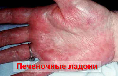 патогенз развития цирроза печени