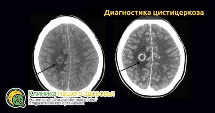Паразиты в мозге: симптомы, виды и лечение