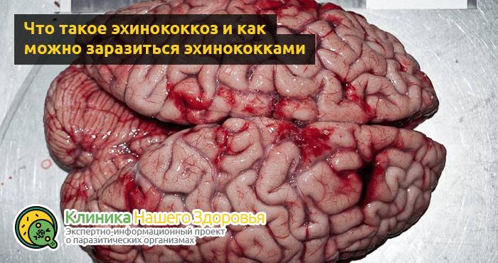 Паразиты в мозге: симптомы, виды и лечение