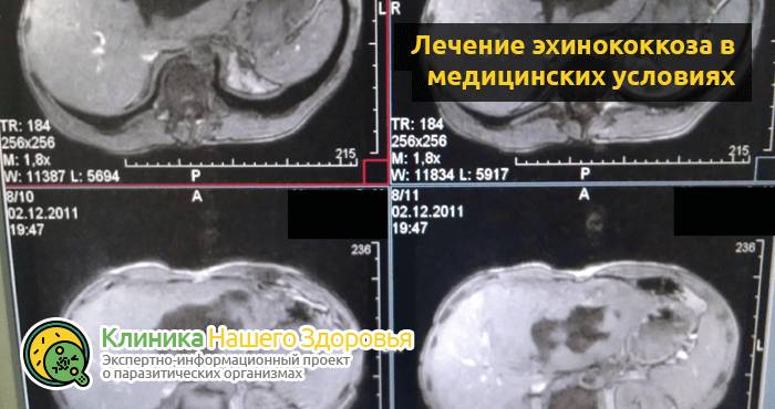 Паразиты в мозге: симптомы, виды и лечение