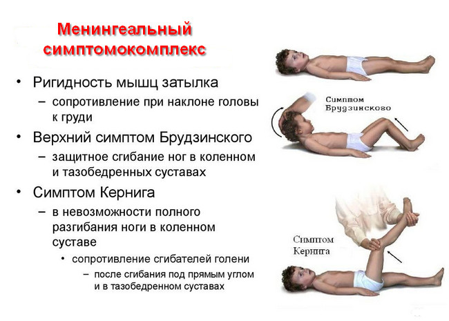 как распознать менингит