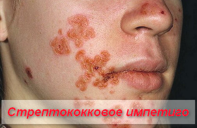 стрептококковое импетиго