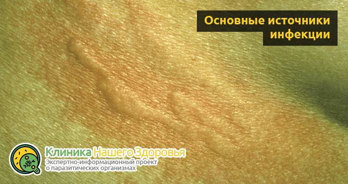 Стронгилоидоз: причины, симптомы, диагностика и лечение болезни