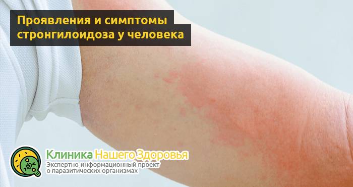 Стронгилоидоз: причины, симптомы, диагностика и лечение болезни