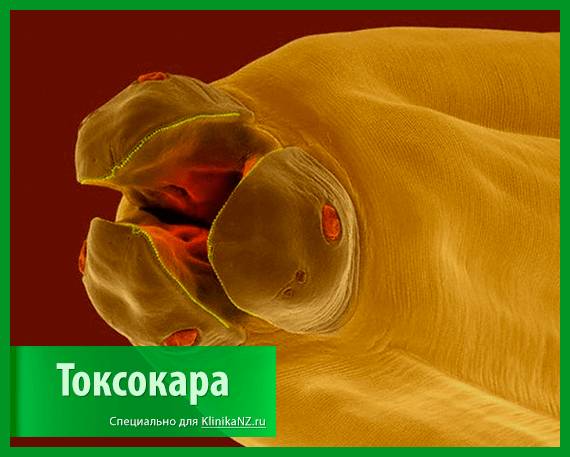 Токсокароз: виды, последствия, диагностика токсокары и лечение