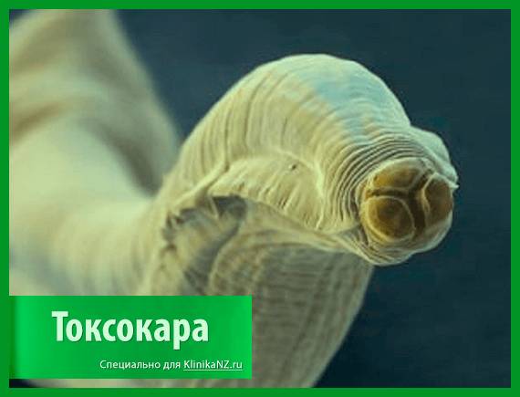 Токсокароз: виды, последствия, диагностика токсокары и лечение