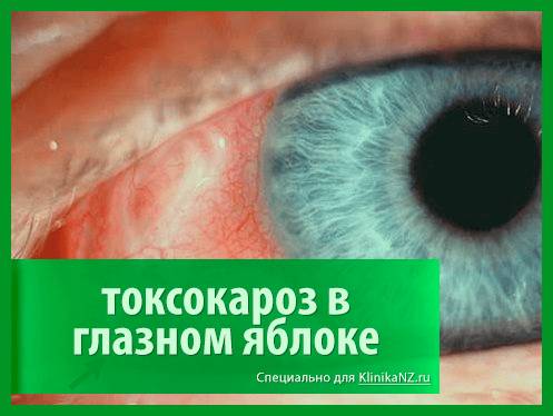 Токсокароз: виды, последствия, диагностика токсокары и лечение