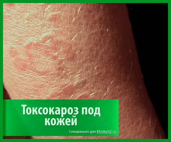Токсокароз: виды, последствия, диагностика токсокары и лечение