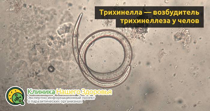 Трихинеллез: причины, симптомы, профилактика и лечение болезни