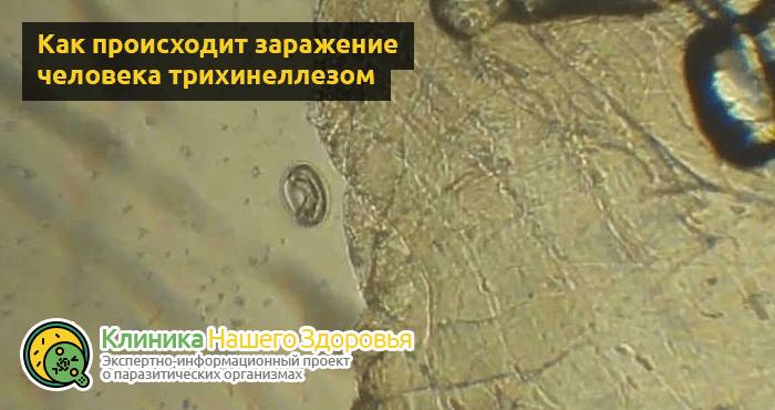 Трихинеллез: причины, симптомы, профилактика и лечение болезни