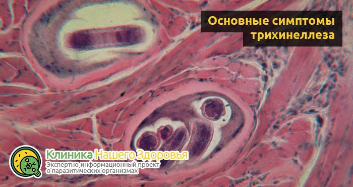Трихинеллез: причины, симптомы, профилактика и лечение болезни