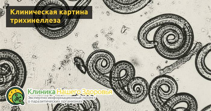 Трихинеллез: причины, симптомы, профилактика и лечение болезни