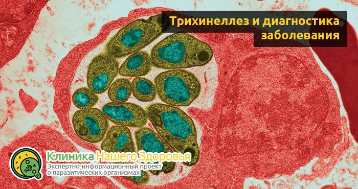 Трихинеллез: причины, симптомы, профилактика и лечение болезни