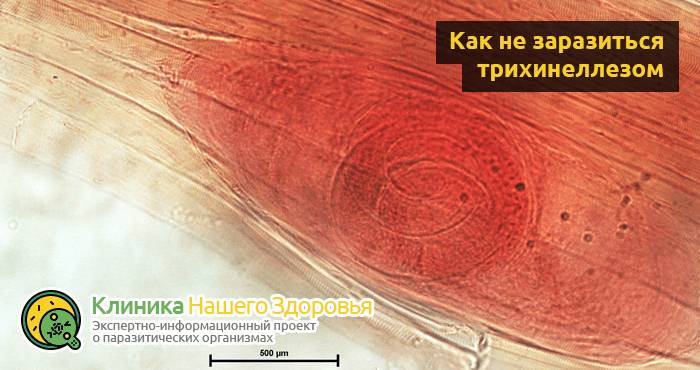 Трихинеллез: причины, симптомы, профилактика и лечение болезни