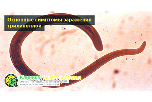 Основные симптомы заражения трихинеллой