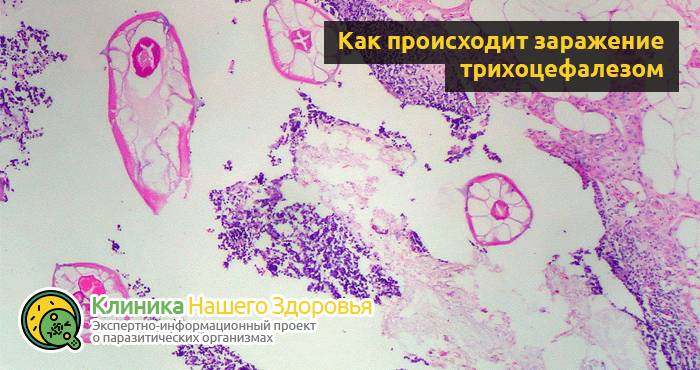 Трихоцефалез человека: симптомы, причины, диагностика и лечение