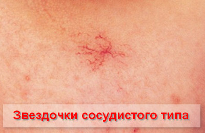 цирроз печени классификация 