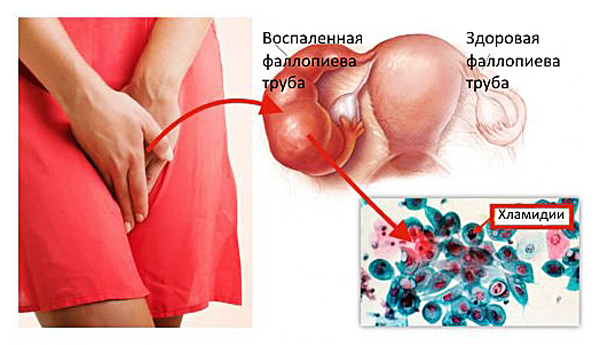 Последствия хламидиоза