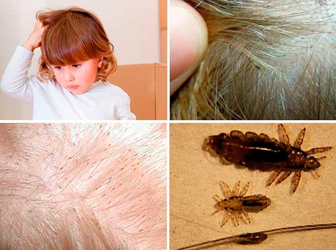 Как сократить до минимума риск заражения педикулезом