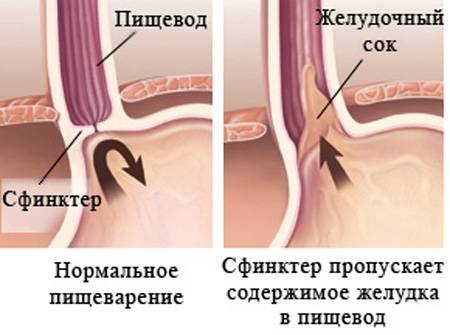Симптомы и стадии заболевания