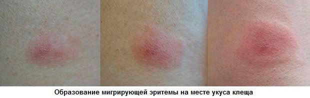I стадия