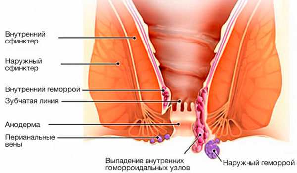 Геморрой
