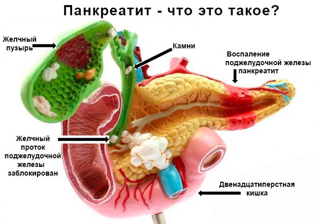 Классификация и причины развития панкреатита