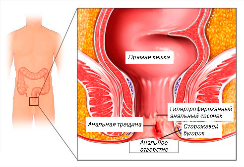 Трещины и кондиломы