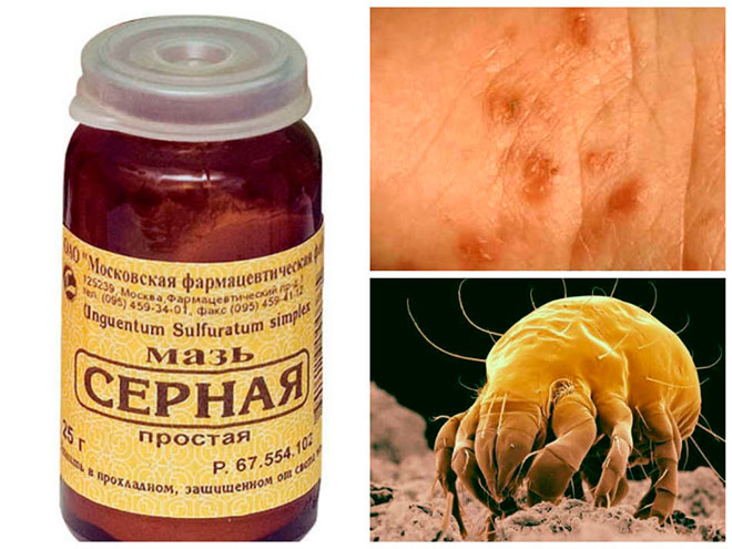 Лечение чесотки с помощью наружных средств